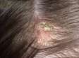 Найдены новые способы лечения сухой себореи кожи головы Найдены новые способы лечения сухой себореи кожи головы